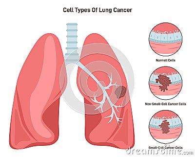 Lung cancer cell types. Pathological malignant cells or tumor located Vector Illustration