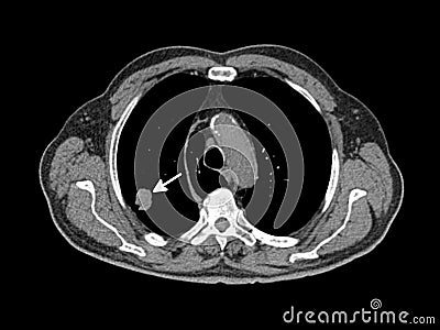 Lung cancer Stock Photo