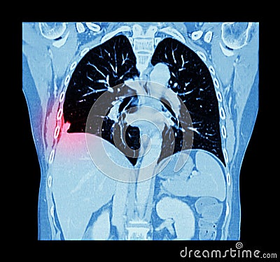 Lung cancer ( CT scan of chest and abdomen : show right lung cancer ) ( Coronal plane ) Stock Photo