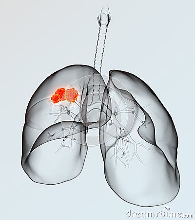 Lung cancer, medically 3D illustration on light background Cartoon Illustration