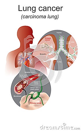 The Lung cancer is a malignant lung tumor characterized by uncontrolled cell growth in tissues of the lung. Lung Stock Photo