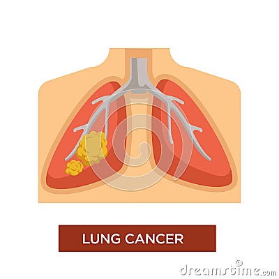 Lung cancer oncology and tumor disease or illness Vector Illustration