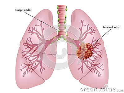 Lung cancer Vector Illustration