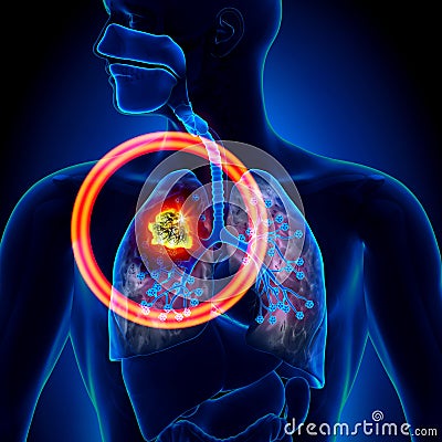 Lung Cancer - Tumor Stock Photo