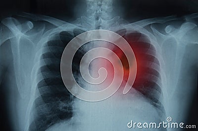 Lung cancer Stock Photo