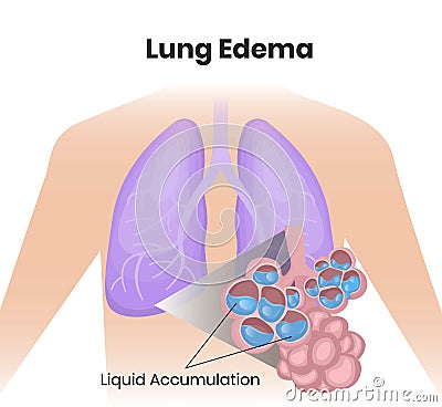 Lung edema illustration. Water collecting inside alveoli Vector Illustration