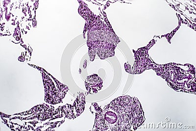Lung emphysema, light micrograph Stock Photo