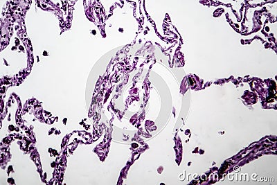 Lung emphysema, light micrograph Stock Photo