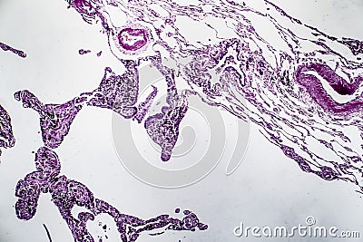 Lung emphysema, light micrograph Stock Photo