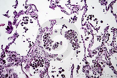Lung emphysema, light micrograph Stock Photo
