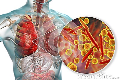 Lung infection caused by bacteria Mycoplasma pneumoniae Cartoon Illustration