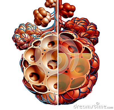 Lung Pulmonary Alveoli With Fluid Diagram Cartoon Illustration