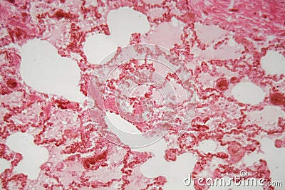 Lung tissue with pneumonia infection caused by flu Viral pneumonia under a microscope Stock Photo