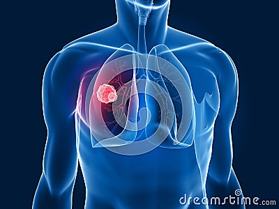 Lung tumor Cartoon Illustration