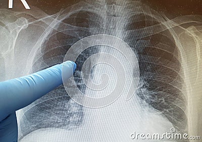 Lung x-ray Stock Photo