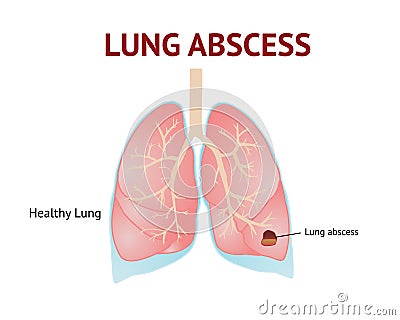 Lungs abscess, lungs disease, isolated vector illustration on White background Vector Illustration