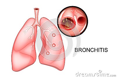 The lungs, affected with bronchitis Vector Illustration