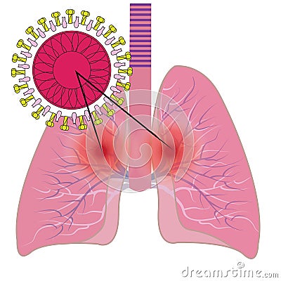 Lungs affected with coronavirus infection COVID19 Vector Illustration