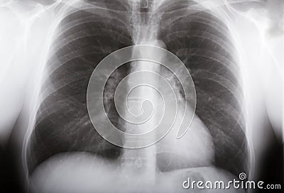 Lungs xray Stock Photo