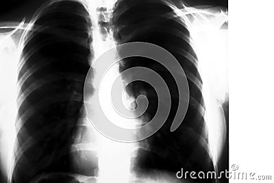 Lungs Xray Stock Photo