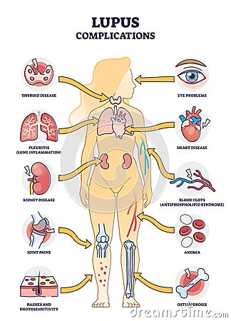 Lupus erythematosus medical autoimmune disease complications outline diagram Vector Illustration