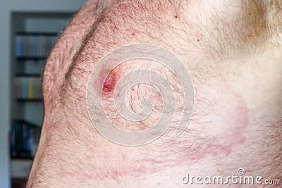 Lyme borreliosis - infectious disease Stock Photo