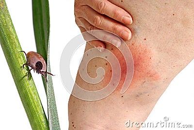 Lyme disease caused by a tick bite on the thigh. Stock Photo