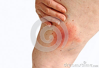 Lyme disease caused by a tick bite on the thigh. Stock Photo