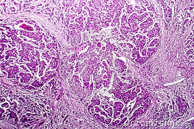 Lymph node metastasis Stock Photo