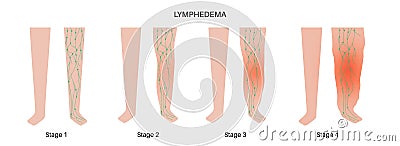 Stages of lymphedema Vector Illustration