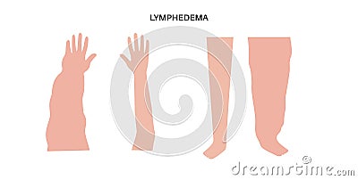 Lymphedema of arm and leg Vector Illustration