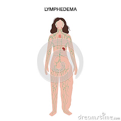 Lymphedema leg swelling Vector Illustration