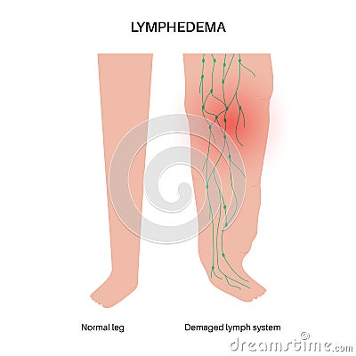 Lymphedema leg swelling Vector Illustration