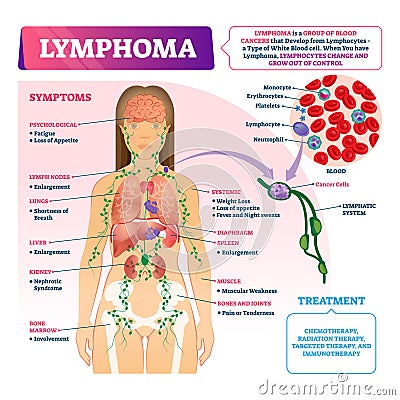 Lymphoma vector illustration. Labeled educational blood cancer type scheme. Vector Illustration