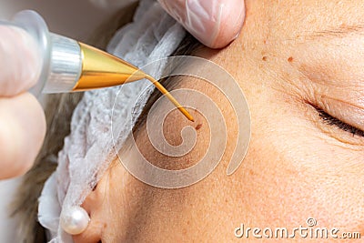 Macro close up of laser plasma pen removing facial wart on middle aged woman Stock Photo