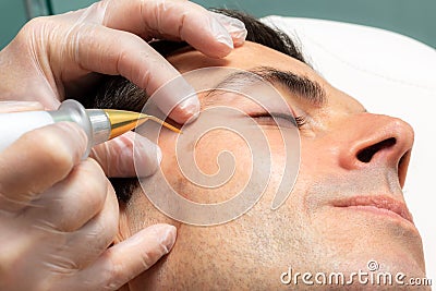 Macro close up of laser plasma pen removing facial melanoma on middle aged man. Stock Photo