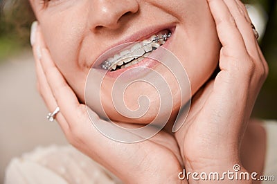 Cropped portrait of a pretty girl, smiling and demonstrating her teeth with ceramic and metal braces Stock Photo