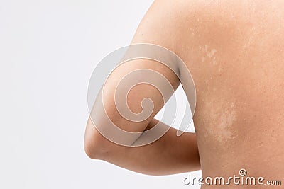 Macro white pityriasis or tinea versicolor on back skin. Used for skincare concept Stock Photo