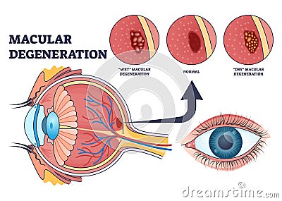 Macular degeneration as eye illness and eyesight problem outline diagram Vector Illustration