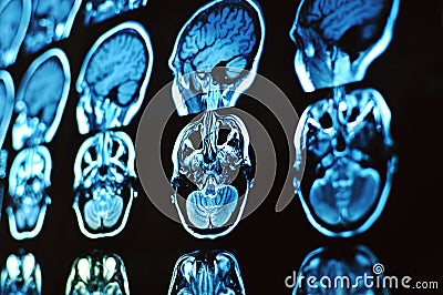 Magnetic resonance image scan of the brain. MRI film of a human skull and brain. Neurology background. Stock Photo