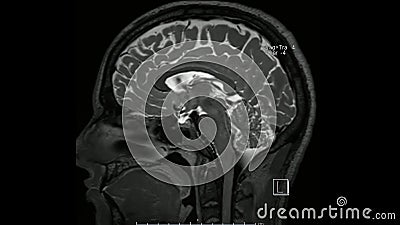 Magnetic resonance images of the brain MRI brain sagittal T2 weighted sequence Stock Photo