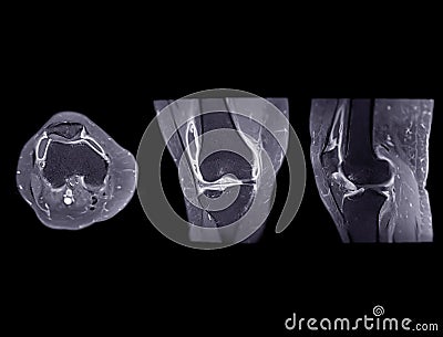 Magnetic resonance imaging or MRI of knee joint Axial ,Coronal and sagittal T2 FS for detect tear or sprain of the anterior Stock Photo