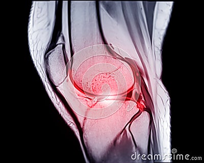 MRI knee sagittal PDW and TIW view for detect tear or sprain of the anterior cruciate ligament & x28;ACL Stock Photo