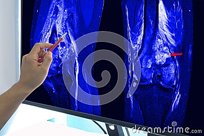 Magnetic Resonance Imaging MRI OF RIGHT KNEE Suggestive of malignant bone tumor, involving epiphysis and metadiaphyses of right Stock Photo