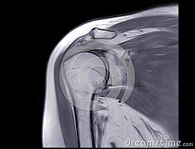 Magnetic Resonance Imaging or MRI of Shoulder Joint Coronal PDW for diagnostic shoulder pain Stock Photo