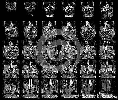 Magnetic resonance imaging MRIOF UPPER ABDOMEN of a patient who has suspected mass-forming hilar cholangiocarcinoma Coronal view Stock Photo