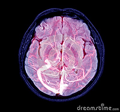 Magnetic resonance venographyMRV Brain of veins in human head.Medical image too soft and blurry when views full solution Stock Photo