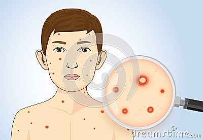 Magnifying chickenpox of children. Vector Illustration