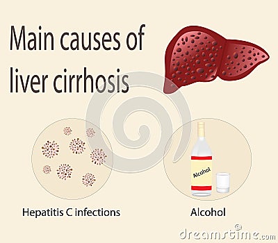 Main causes of liver cirrhosis Vector Illustration