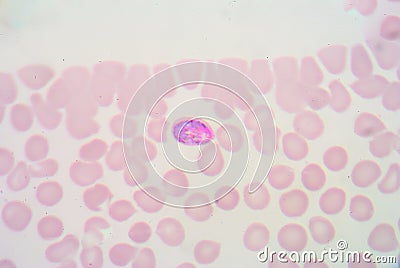 Malaria blood smear pictures Stock Photo